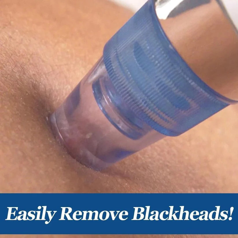 4-in-1 blackhead extractor – vacuum suction acne remover & pore cleaner